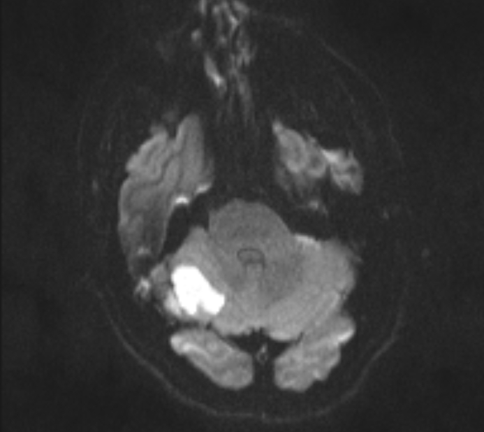 Acute ischemic stroke - posterior circulation territory (Radiopaedia 77670-89880 Axial DWI 30).jpg