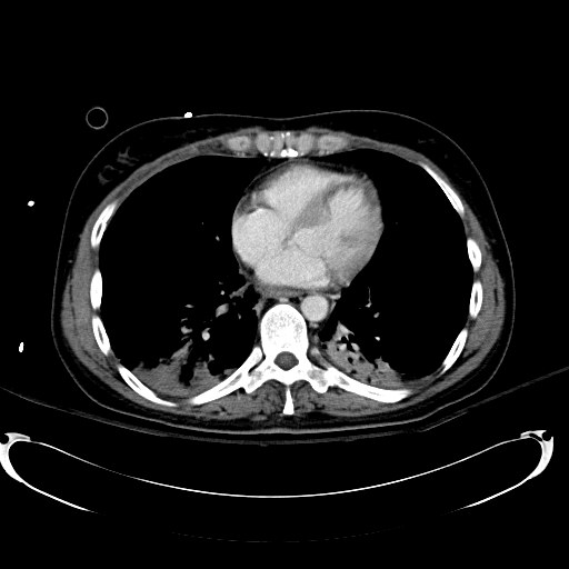Acute myocardial infarction in CT (Radiopaedia 39947-42415 Axial C+ portal venous phase 1).jpg