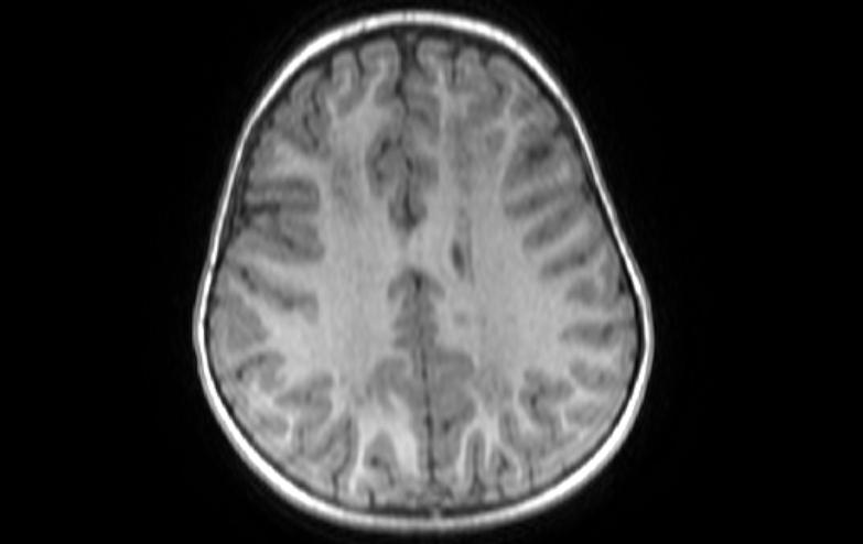 File:Acute necrotizing encephalitis of childhood (Radiopaedia 67356-76737 Axial T1 29).jpg