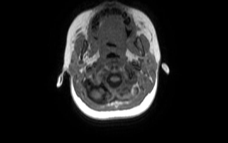 File:Acute necrotizing encephalitis of childhood (Radiopaedia 67356-76737 Axial T1 91).jpg
