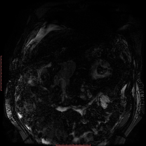 Acute necrotizing pancreatitis (Radiopaedia 28194-28448 Coronal MRCP 81).jpg