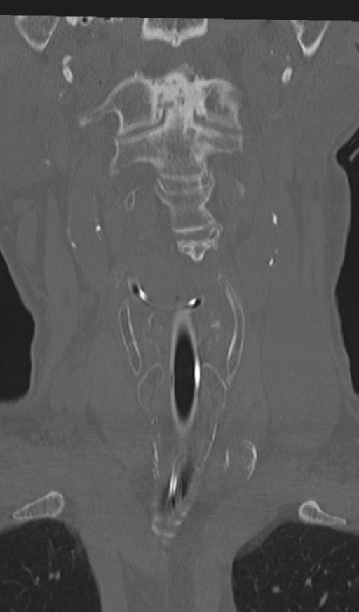 Acute on chronic subdural hematoma and thoracic vertebral injury in a multitrauma patient (Radiopaedia 31698-32619 Coronal bone window 11).jpg