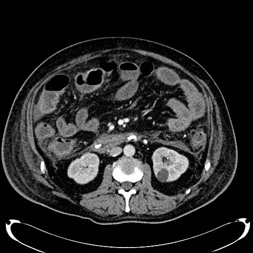 Acute pancreatic necrosis (Radiopaedia 13560-18500 Axial C+ portal venous phase 78).jpg
