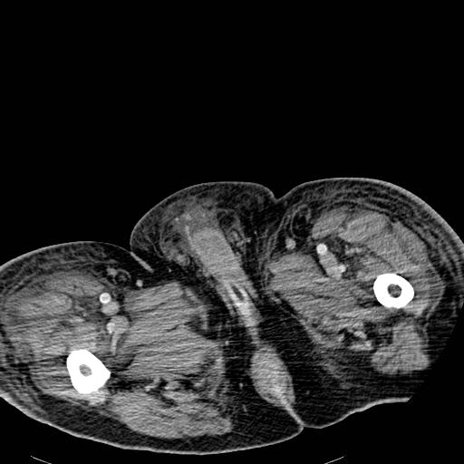 Acute pancreatic necrosis (Radiopaedia 13560-18501 Axial C+ portal venous phase 165).jpg