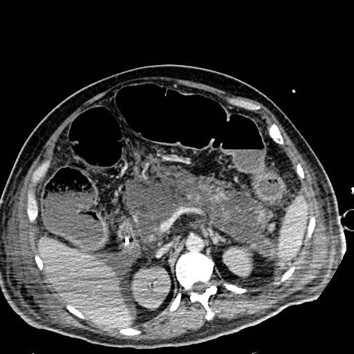Acute pancreatic necrosis (Radiopaedia 13560-18501 Axial C+ portal venous phase 47).jpg