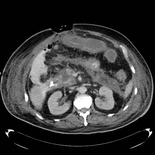 Acute pancreatic necrosis (Radiopaedia 13560-18503 Axial C+ portal venous phase 30).jpg