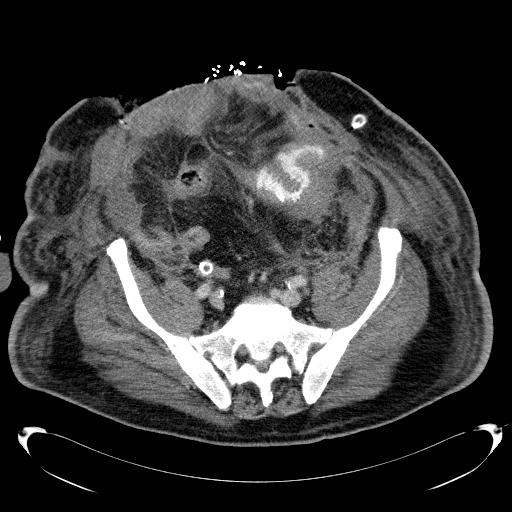 Acute pancreatic necrosis (Radiopaedia 13560-18503 Axial C+ portal venous phase 61).jpg