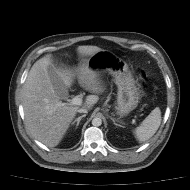 Acute pancreatitis (Radiopaedia 26663-26813 Axial C+ portal venous phase 21).jpg