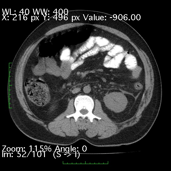 Acute pancreatitis (Radiopaedia 34043-35276 Axial non-contrast 52).jpg