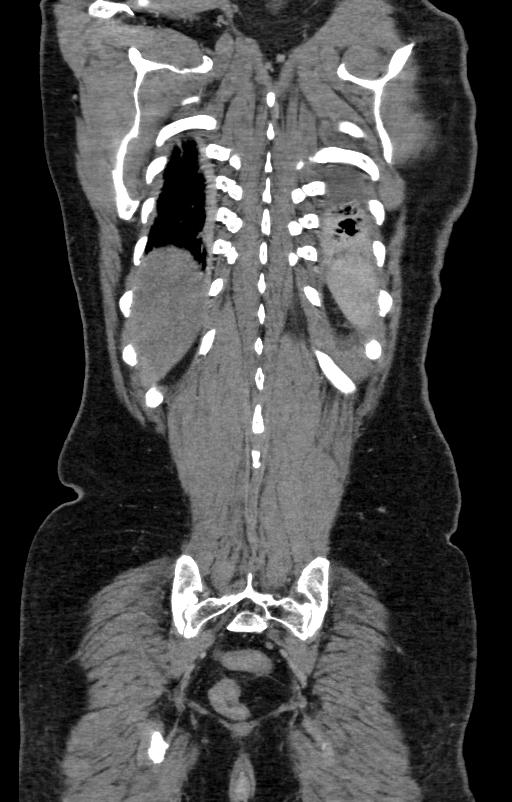 Acute pancreatitis (Radiopaedia 80007-93285 Coronal C+ portal venous phase 129).jpg