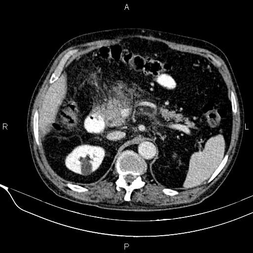 Acute pancreatitis (Radiopaedia 85146-100701 Axial C+ portal venous phase 24).jpg