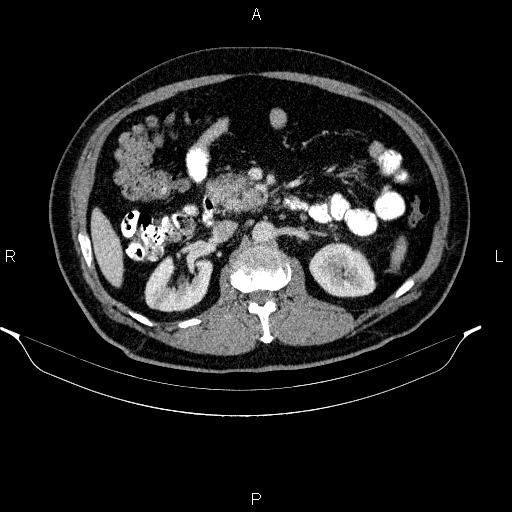 Acute pancreatitis (Radiopaedia 85390-101010 Axial C+ portal venous phase 43).jpg