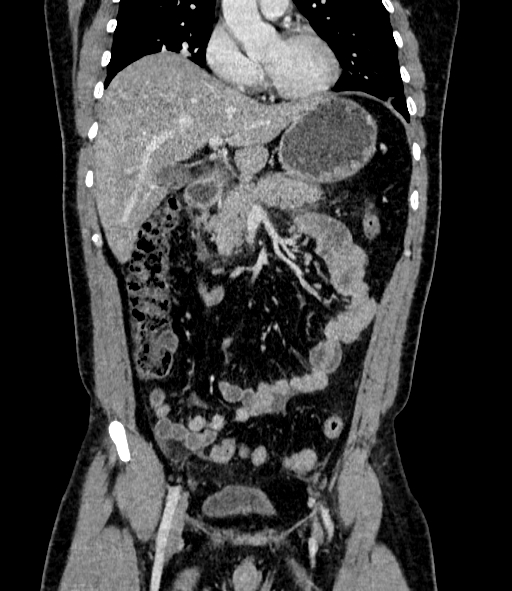 Acute pancreatitis (Radiopaedia 87428-103757 Coronal C+ portal venous phase 37).jpg