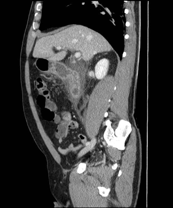 Acute pancreatitis - Balthazar E (Radiopaedia 23080-23110 Sagittal C+ portal venous phase 34).jpg