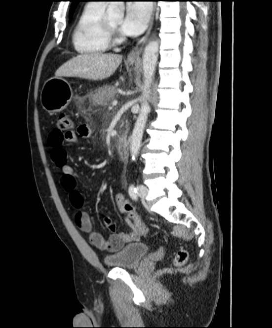 Acute pancreatitis - Balthazar E (Radiopaedia 23080-23110 Sagittal C+ portal venous phase 54).jpg