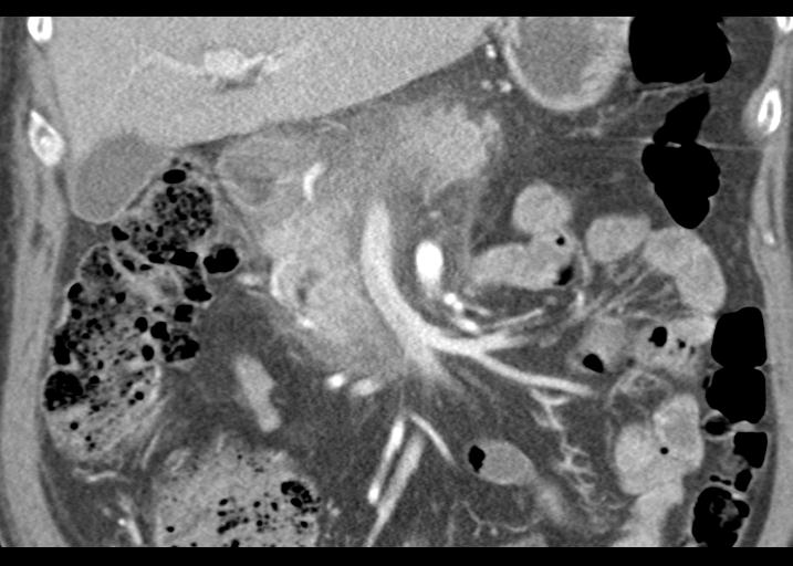 Acute pancreatitis and walled-off necrosis (Radiopaedia 29888-30403 Coronal C+ portal venous phase 24).jpg