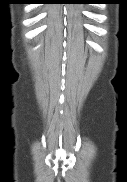 Acute pancreatitis and walled-off necrosis (Radiopaedia 29888-30403 E 51).jpg