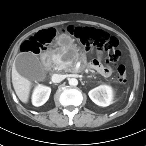 File:Acute pancreatitis and walled-off necrosis (Radiopaedia 29888-30404 Axial C+ portal venous phase 30).jpg