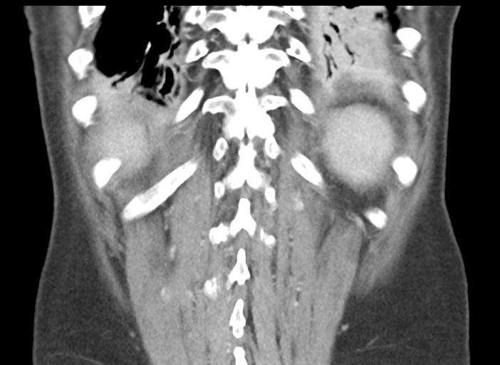 Acute pancreatitis and walled-off necrosis (Radiopaedia 29888-30404 Coronal C+ portal venous phase 45).jpg