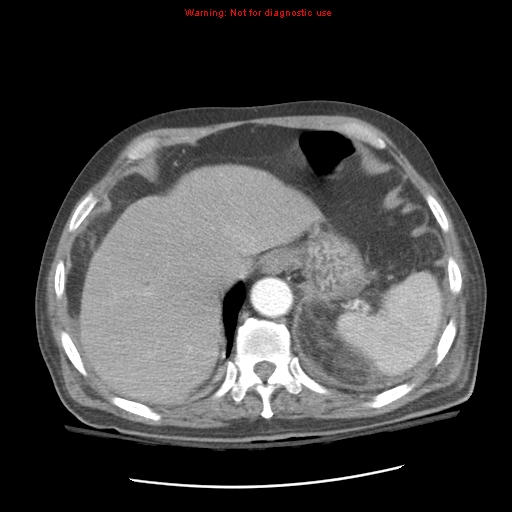 File:Acute pancreatitis with incidental pancreatic lipoma (Radiopaedia 10190-10730 Axial C+ arterial phase 20).jpg