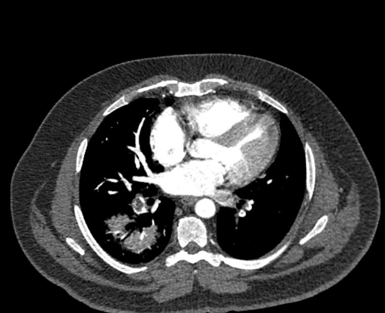 Acute pulmonary embolism with pulmonary infarcts (Radiopaedia 77688-89908 Axial C+ CTPA 37).jpg