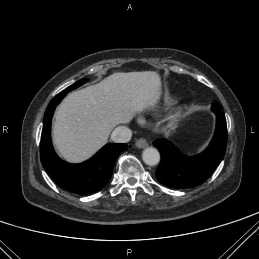 File:Acute renal artery occlusion (Radiopaedia 86586-102682 Axial C+ portal venous phase 3).jpg