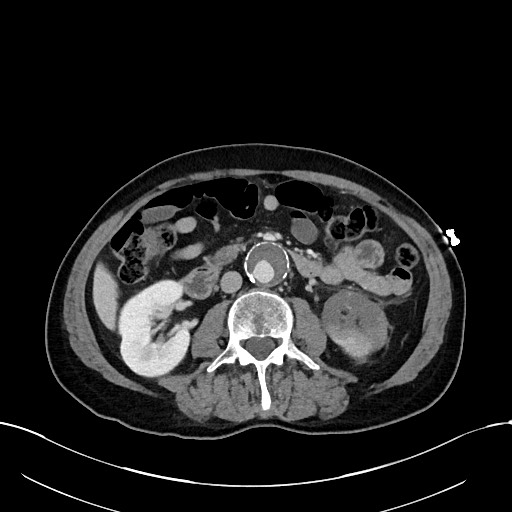 Acute renal infarction (Radiopaedia 59375-66736 Axial C+ portal venous phase 48).jpg