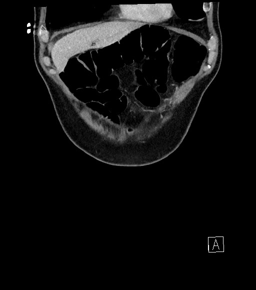 Acute renal infarction (Radiopaedia 59375-66736 Coronal C+ portal venous phase 13).jpg