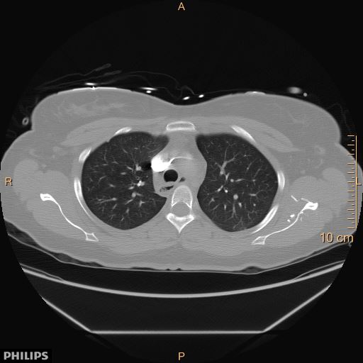 File:Acute reversible pulmonary hypertension and right heart failure from cocaine toxicity (Radiopaedia 49394-54517 Axial 11).jpg