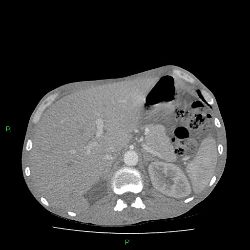 File:Acute right lung abscess (Radiopaedia 34806-36258 Axial C+ arterial phase 187).jpg