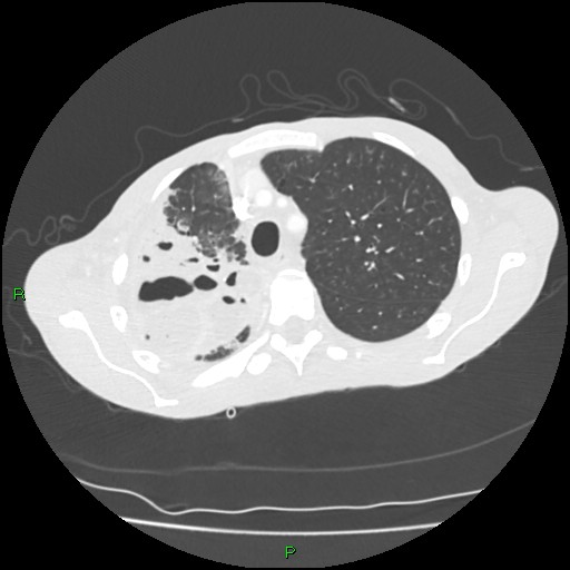 Acute right lung abscess (Radiopaedia 34806-36258 Axial lung window 45).jpg