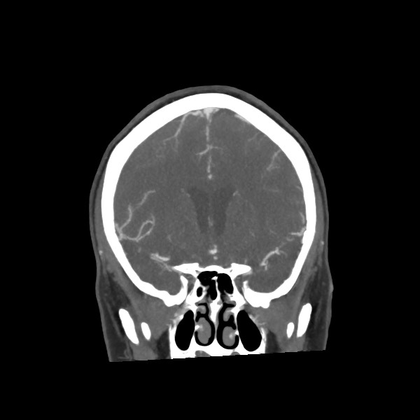 Acute subarachnoid hemorrhage and accessory anterior cerebral artery (Radiopaedia 69231-79009 Coronal C+ arterial phase 32).jpg