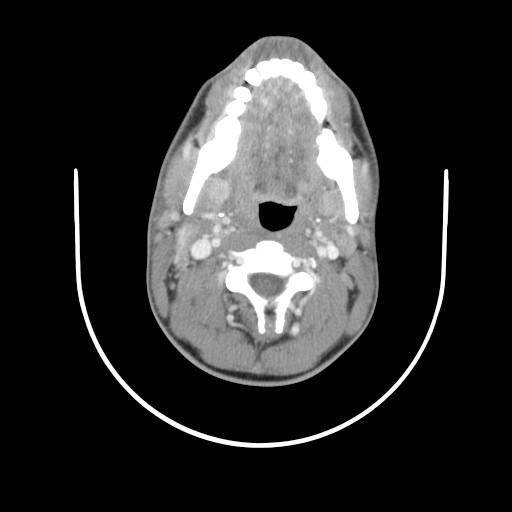 File:Acute submandibular sialadenitis secondary to ductal stone (Radiopaedia 27999-28267 Axial C+ delayed 20).jpg