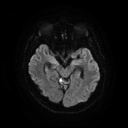 Acute superior cerebellar artery territory infarct (Radiopaedia 84104-99358 Axial DWI 53).jpg