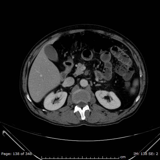 Acute superior mesenteric artery occlusion (Radiopaedia 43636-47060 Axial C+ portal venous phase 14).jpg