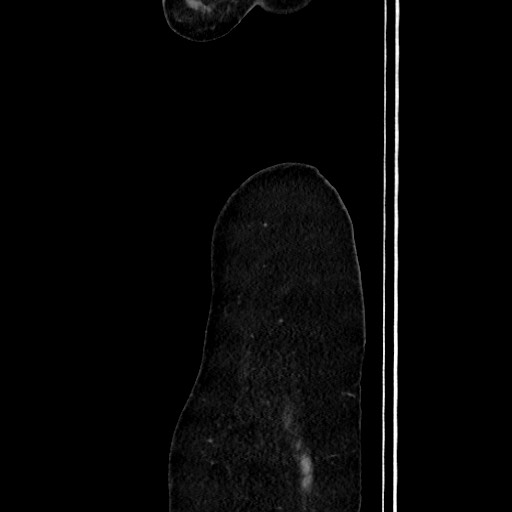 Acute uncomplicated appendicitis (Radiopaedia 73704-84499 Sagittal C+ portal venous phase 26).jpg