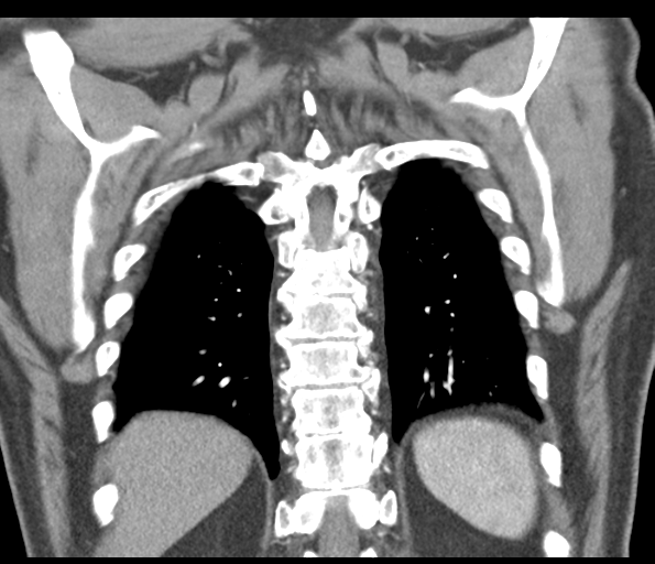 Adenocarcioma of rectum- T1 lesion (Radiopaedia 36921-38547 Coronal C+ arterial phase 50).png