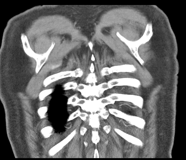 Adenocarcioma of rectum- T1 lesion (Radiopaedia 36921-38547 Coronal C+ arterial phase 55).png