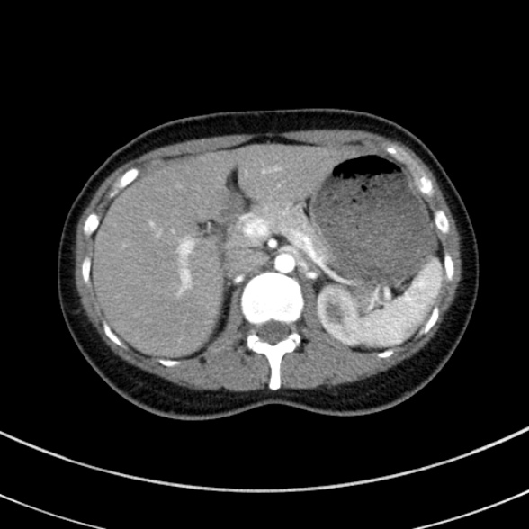 Adenocystic carcinoma of the trachea (Radiopaedia 47677-52525 Axial C+ arterial phase 81).jpg