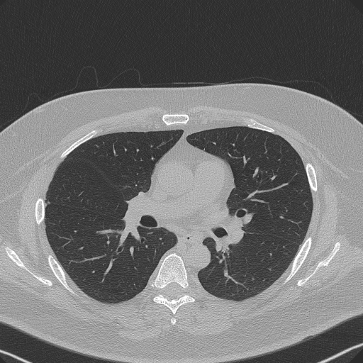 Adenoid cystic carcinoma of the trachea (Radiopaedia 49042-54137 Axial lung window 164).jpg