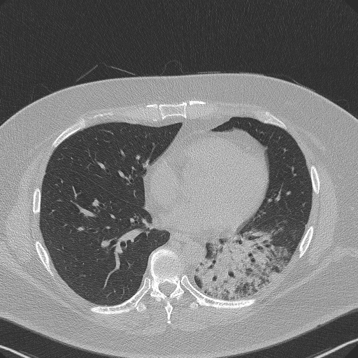 Adenoid cystic carcinoma of the trachea (Radiopaedia 49042-54137 Axial lung window 214).jpg