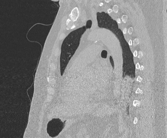 Adenoid cystic carcinoma of the trachea (Radiopaedia 49042-54137 Sagittal lung window 278).jpg