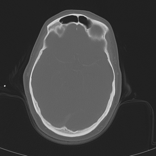Adenoid cystic tumor of palate (Radiopaedia 46980-51518 Axial bone window 7).png
