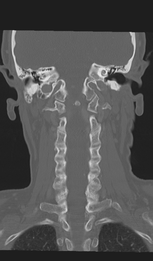 Adenoid cystic tumor of palate (Radiopaedia 46980-51518 Coronal bone window 43).png