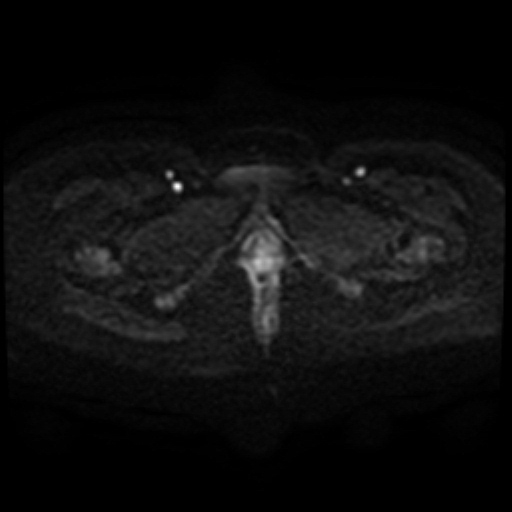 Adenoma malignum of cervix (Radiopaedia 66441-75705 Axial DWI 101).jpg