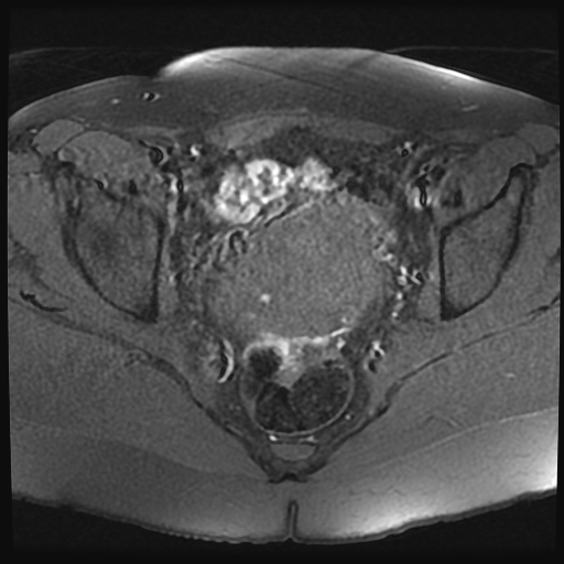 File:Adenomyosis-scar endometriosis (Radiopaedia 65863-75022 Axial T1 fat sat 16).jpg