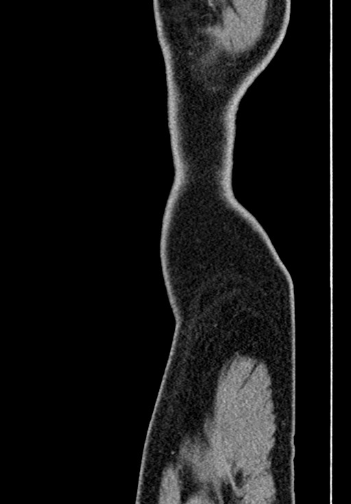 Adhesional small bowel obstruction (Radiopaedia 58900-66131 Sagittal C+ portal venous phase 3).jpg