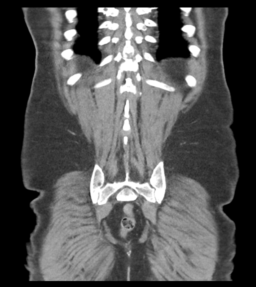 Adhesions within abdominal wall hernia (Radiopaedia 58283-65394 Coronal C+ portal venous phase 59).png