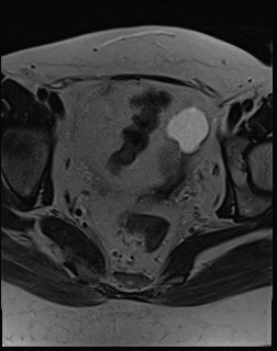 File:Adnexal multilocular cyst (O-RADS US 3- O-RADS MRI 3) (Radiopaedia 87426-103754 Axial T2 15).jpg