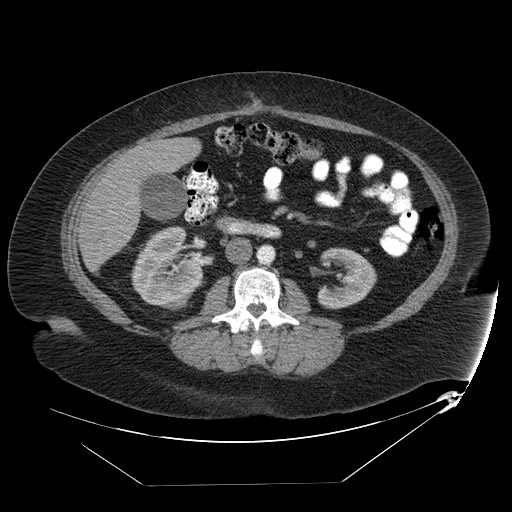 Adrenal angiosarcoma (Radiopaedia 81081-94671 Axial C+ arterial phase 39).jpg